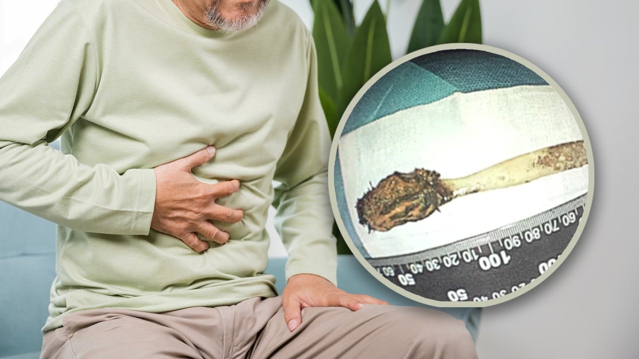 Chinese man, 64, finds toothbrush he swallowed at age 12 stuck in intestine