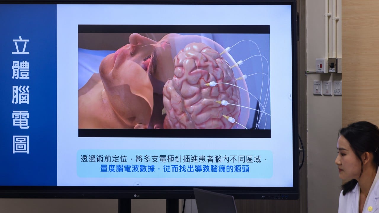 How a Hong Kong man’s drug-resistant epilepsy was relieved using robotics