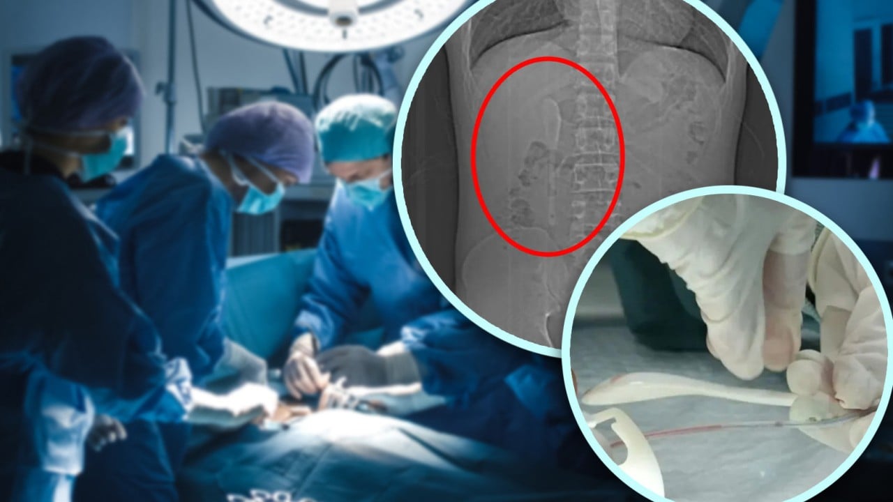 Drunk Chinese man swallows spoon, thinks it was a dream, learns 5 months later