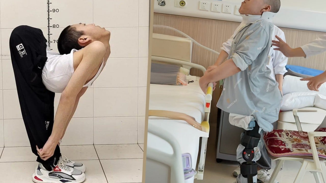 China ‘folded boy’ stands up straight for first time after gruelling surgeries