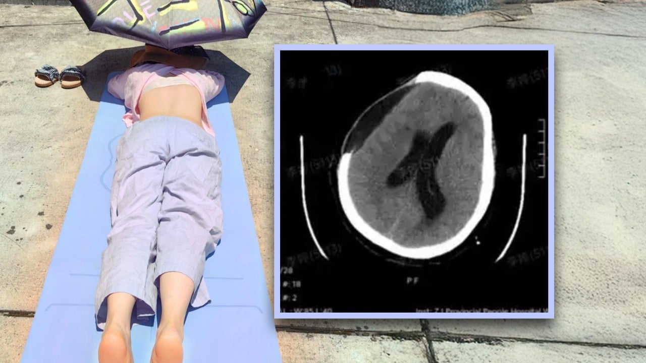 China woman suffers brain haemorrhage, in coma after sunbathing to improve health