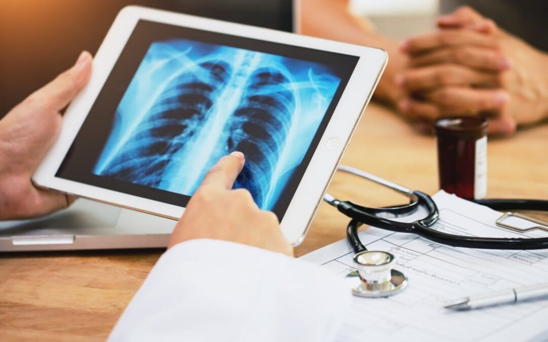 Patients given more hope as study finds best time for lung cancer treatment