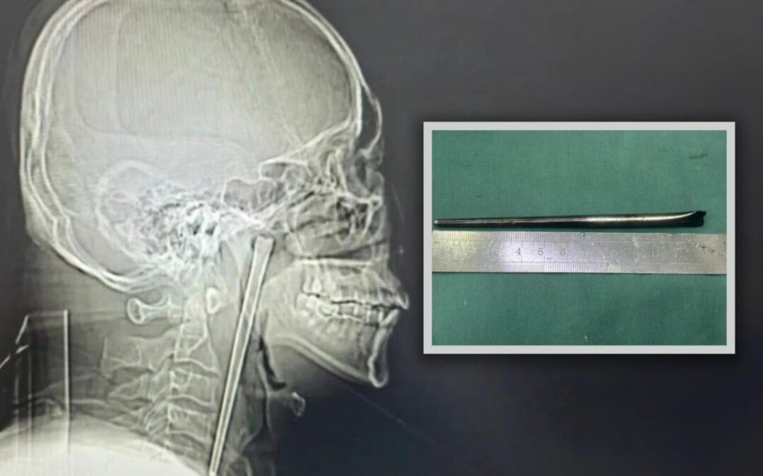 Chinese man lives for 8 years with chopstick stuck in throat, resisting surgery due to fear