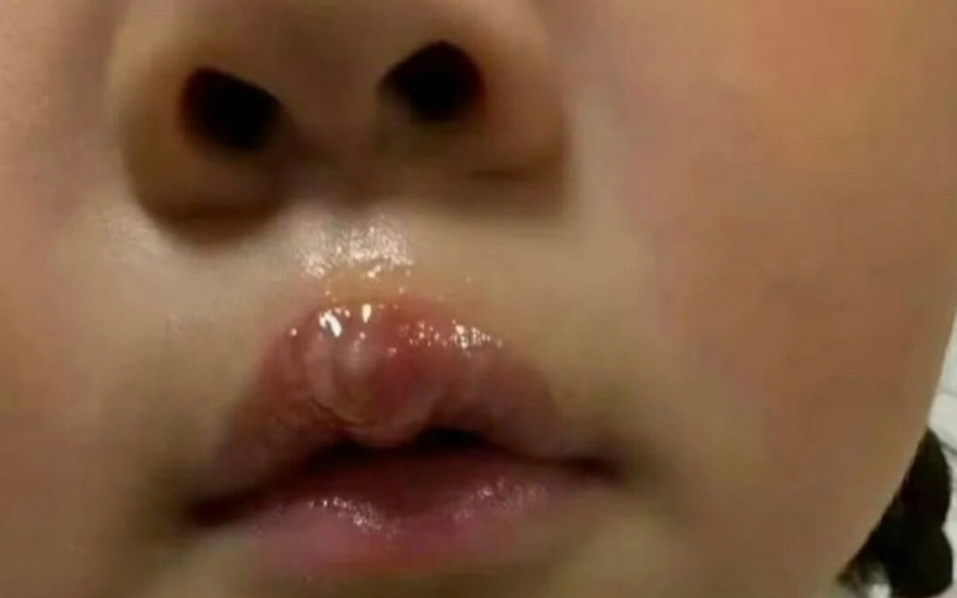 China teacher under probe after using glue gun to scald little girl, resulting in blisters