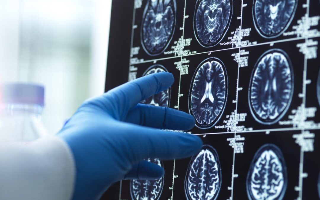 ‘A completely new person’: can surgery help Alzheimer’s patients regain basic skills?